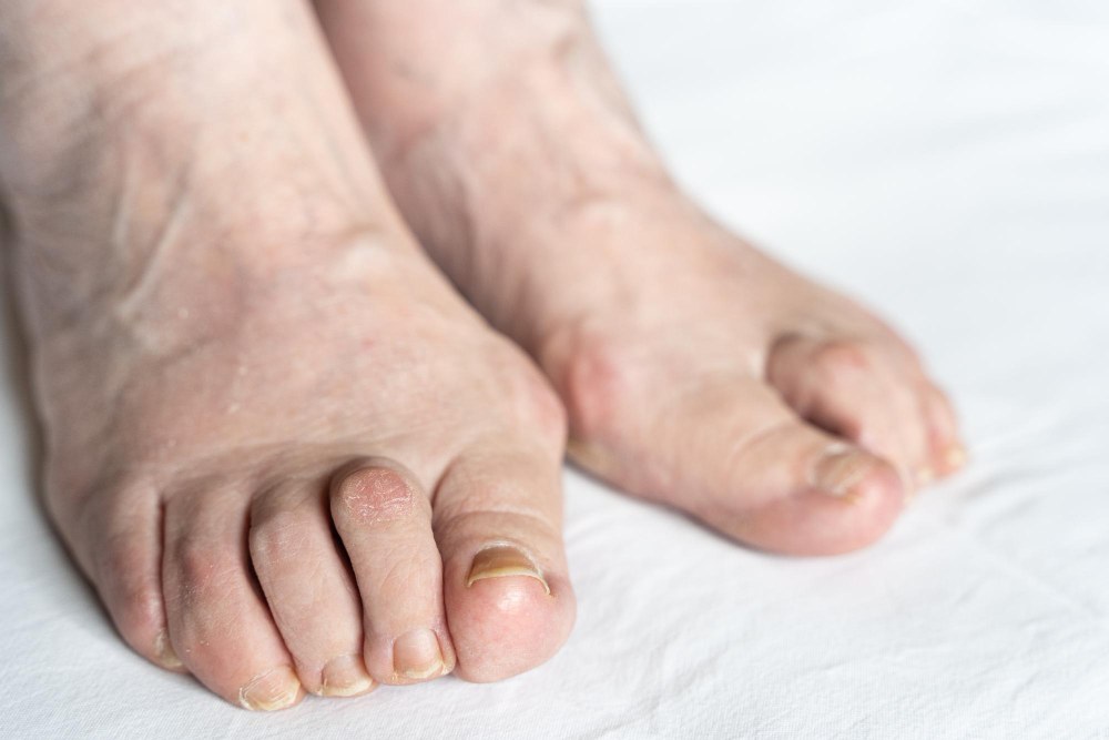 Lapiplasty 3D Bunion Correction