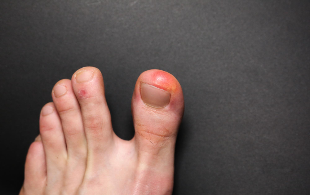Wound Care